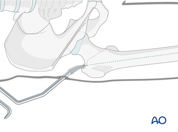 antegrade nailing approach with piriformis entry point