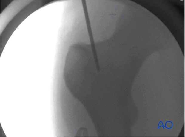 antegrade nailing approach with piriformis entry point