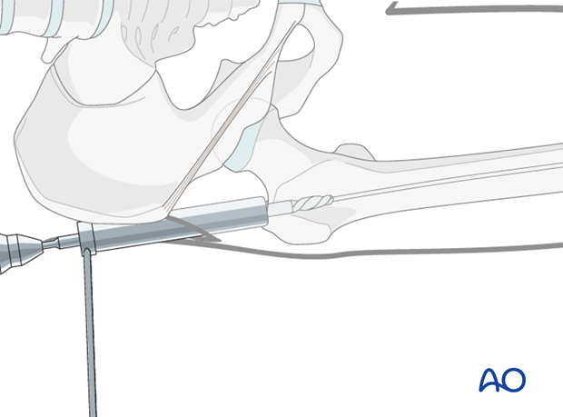 antegrade nailing approach with piriformis entry point