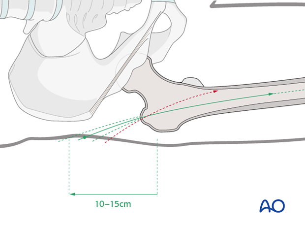 Antegrade nailing femoral shaft – trochanteric entry point – Too distal