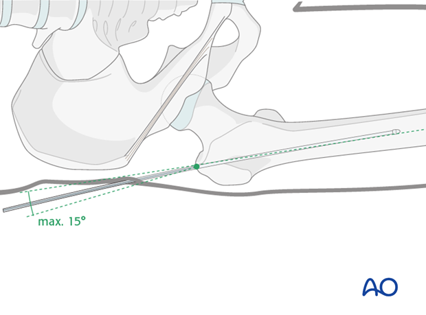 Antegrade nailing femoral shaft – trochanteric entry point – Guide wire