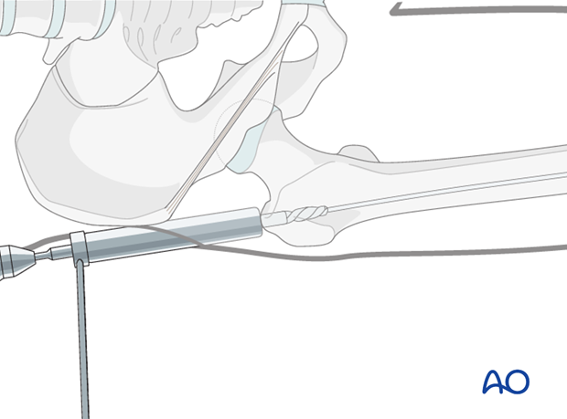 Antegrade nailing femoral shaft – trochanteric entry point – Opening the canal