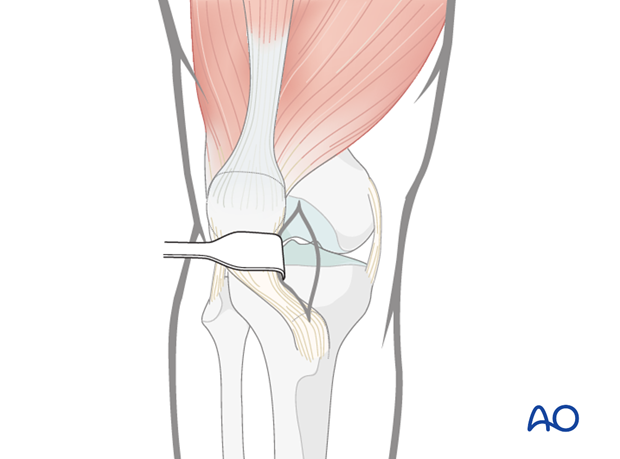 Retrograde nailing femoral shaft – Dissection