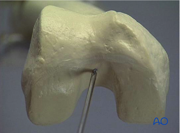 Retrograde nailing femoral shaft – Entry point