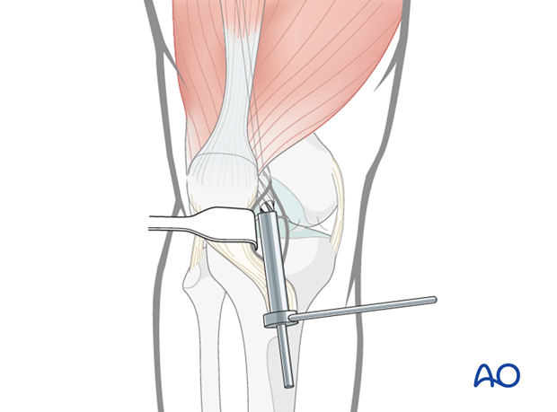 Retrograde nailing femoral shaft – Opening medullary canal drilling