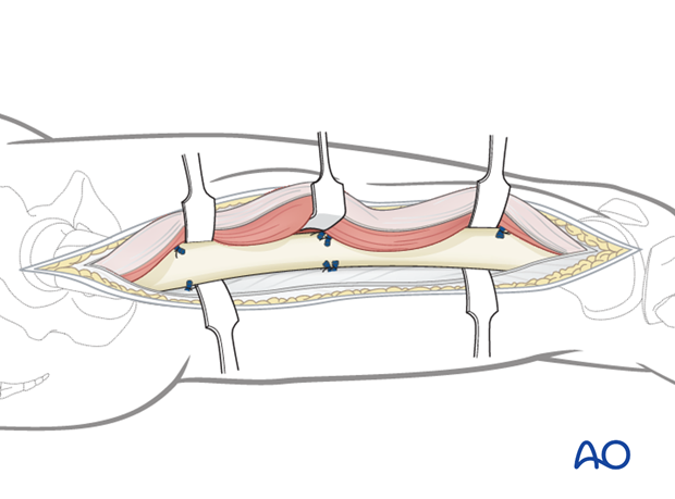 Lateral approach to femoral shaft – Exposure of femoral shaft