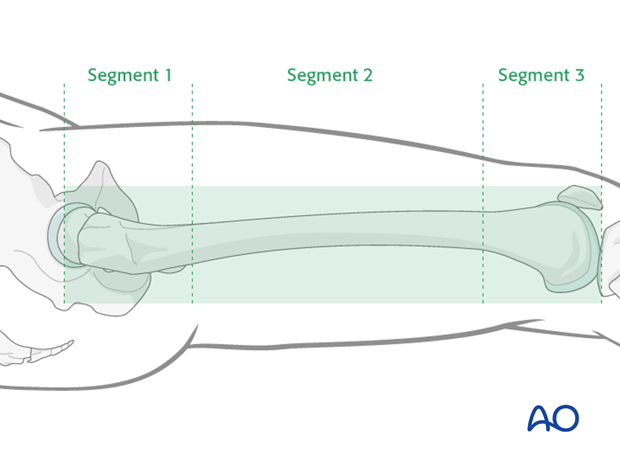 Minimally invasive osteosynthesis – Approach femur