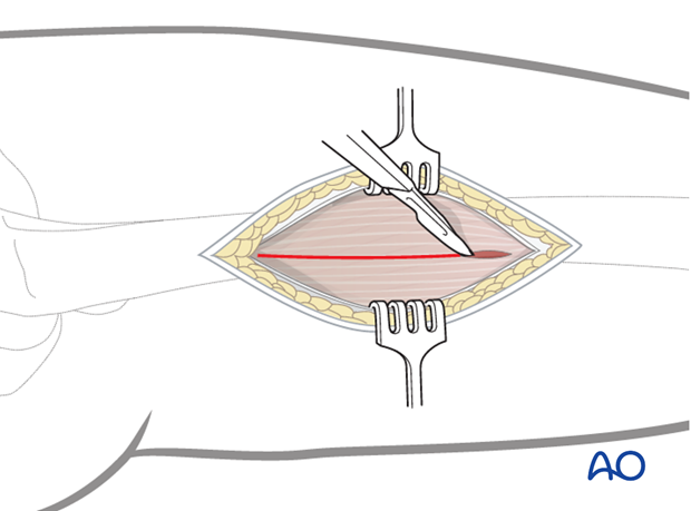 Minimally invasive osteosynthesis – Approach femur – Midshaft – Vastus lateralis