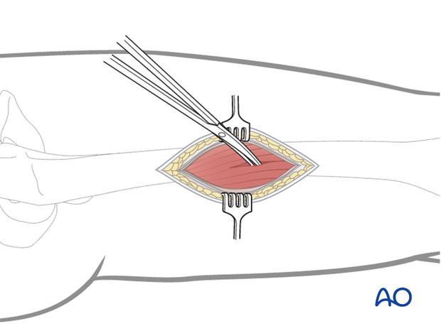 Minimally invasive osteosynthesis – Approach femur – Midshaft - Dissection