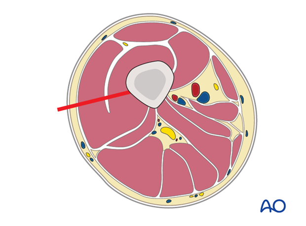 Minimally invasive osteosynthesis – Approach femur – Midshaft - Dissection