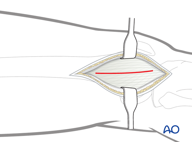 Minimally invasive osteosynthesis – Approach femur – Midshaft – Distal femoral shaft