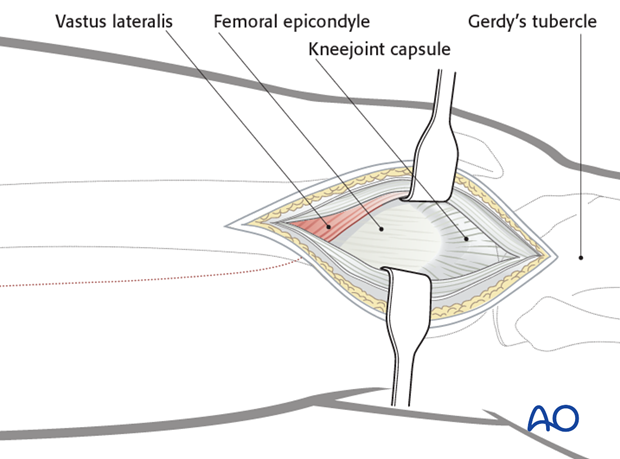 Minimally invasive osteosynthesis – Approach femur – Midshaft – Distal femoral shaft