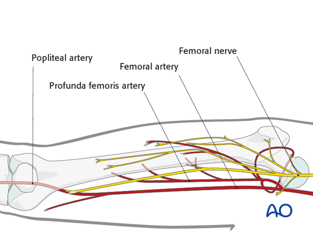 Safe zones femoral shaft