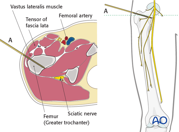 Safe zones femoral shaft – Proximal third