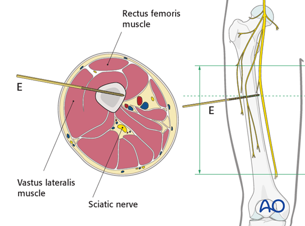 Safe zones femoral shaft – Proximal third – Direct lateral