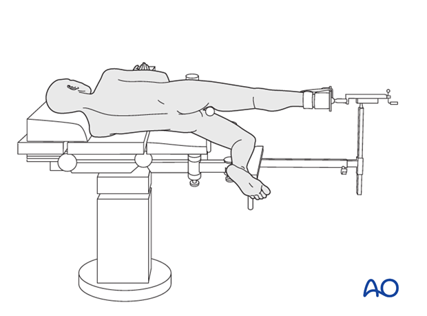 Supine positioning with abducted contralateral leg