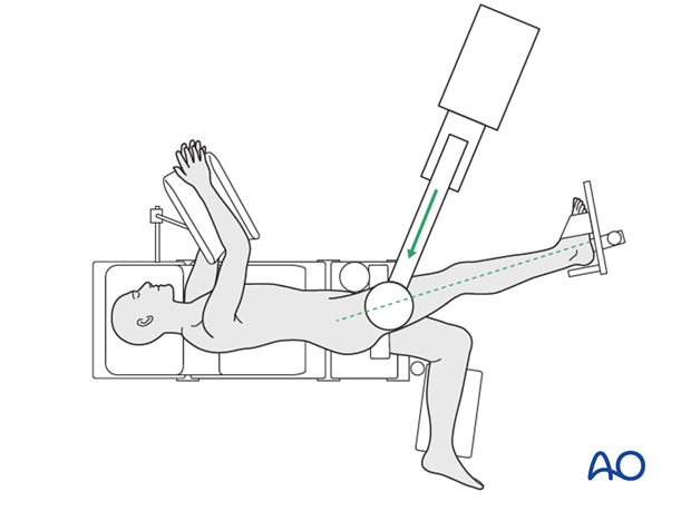 lateral decubitus position