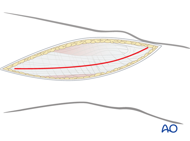 Division of the iliotibial band