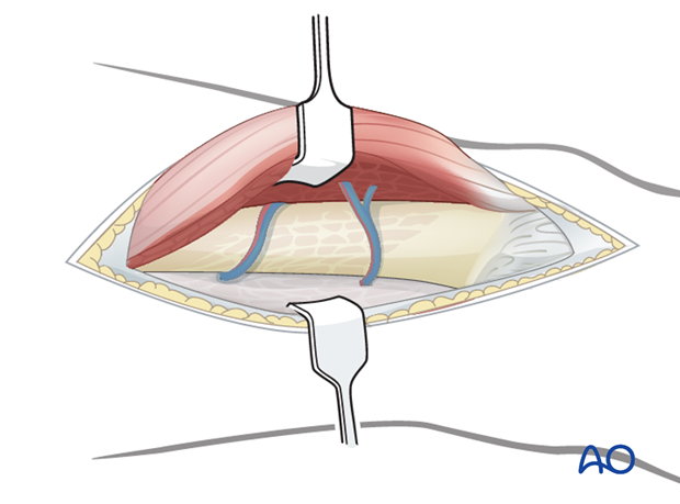 Retraction of vastus lateralis