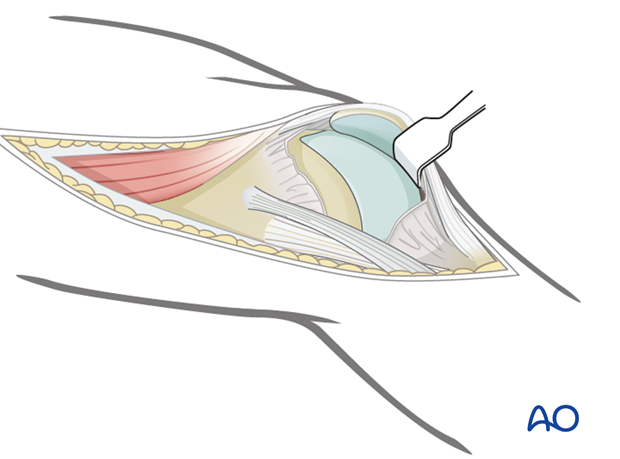 Capsule arthrotomy