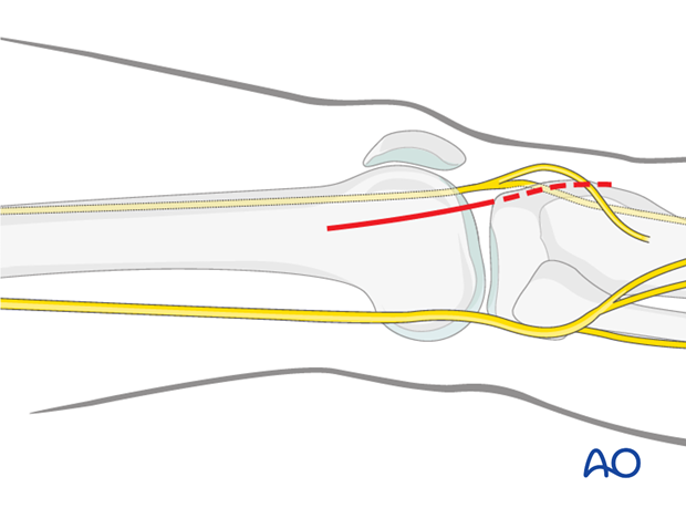 Distal skin incision