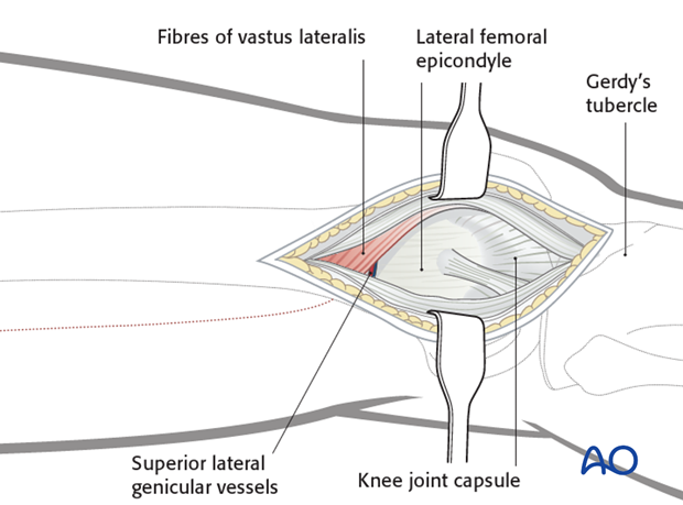 Vastus lateralis