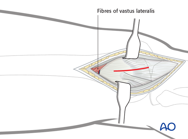 Joint capsule arthrotomy