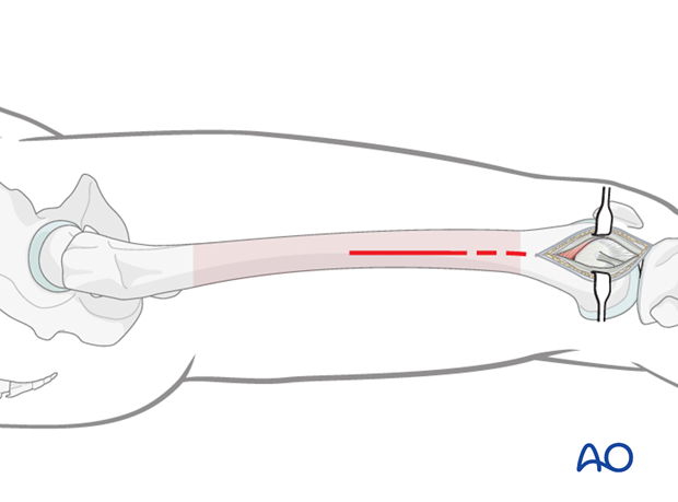 Proximal skin incision