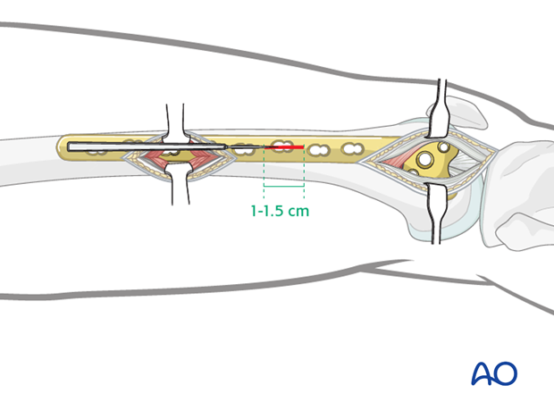 Stab incisions