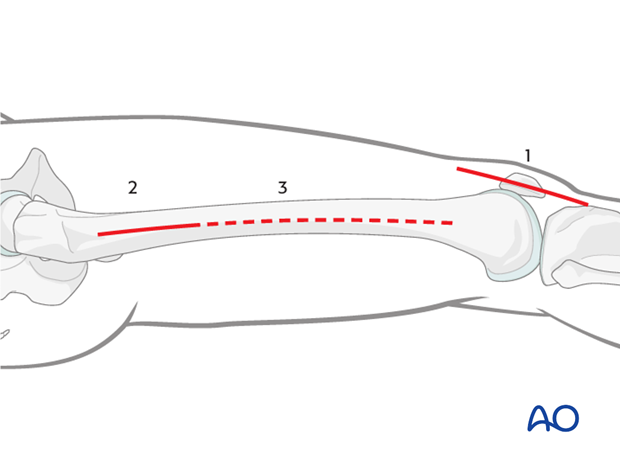 Extensions of the lateral parapatellar approach