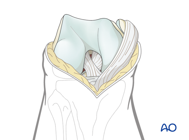 Distal extension of the deep dissection