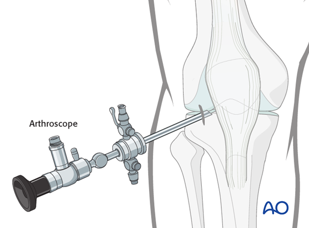 Anterolateral port preparation