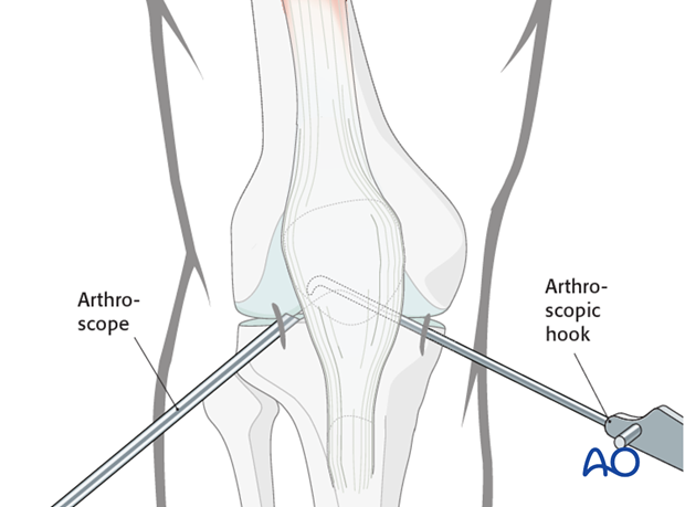 Stab incision