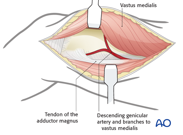 medial approach to the distal femur