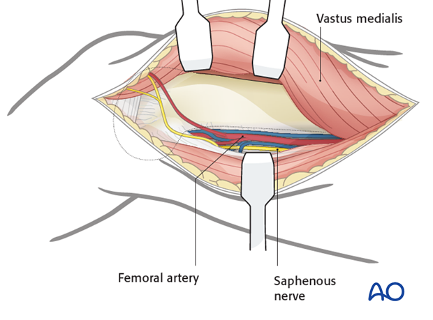 The popliteal neurovascular bundle 