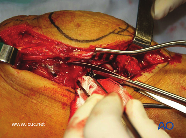 Lateral parapatellar approach with surface landmarks indicated, showing patella and tibial tubercle