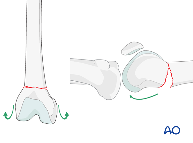 Paradoxal notch view