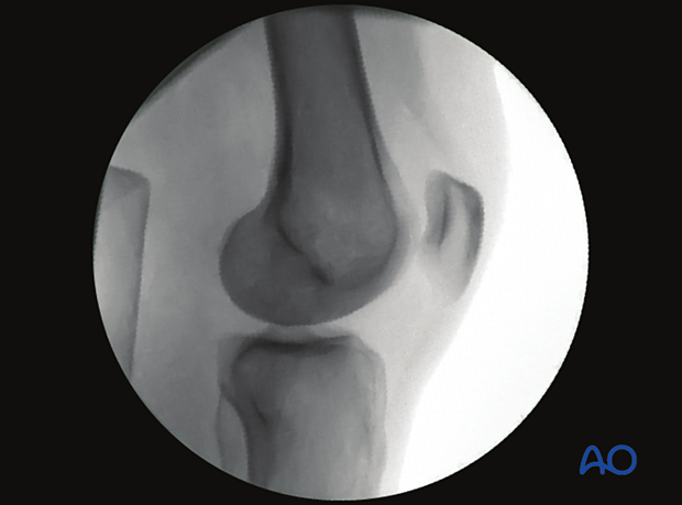 Optimal lateral view of distal femur