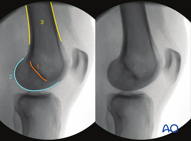 Anatomical landmarks and lines lateral view of distal femur