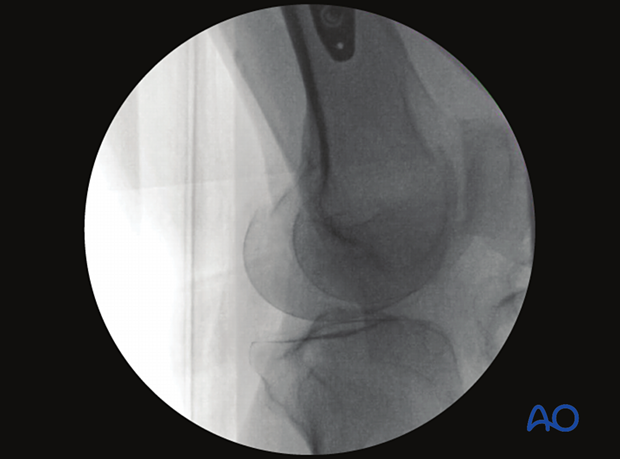 Optimal view of distal femur