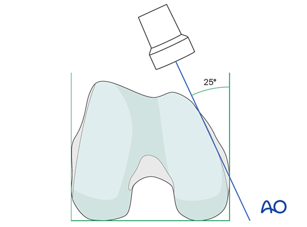 Positioning for optimal 25 degrees external rollover view