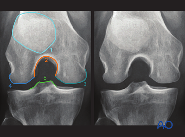 Anatomical landmarks and lines in the notch view