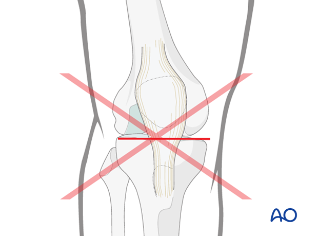 mid axial longitudinal approach