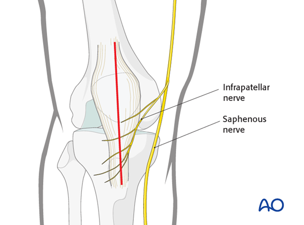 mid axial longitudinal approach