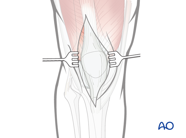 mid axial longitudinal approach