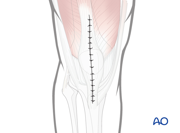 mid axial longitudinal approach