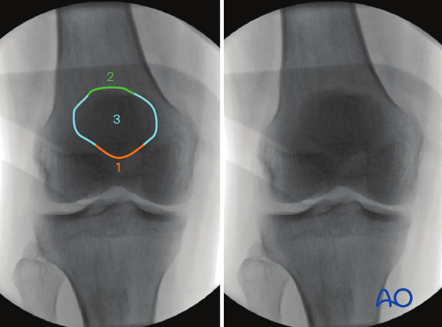 34 X550 Intraoperative imaging of the patella