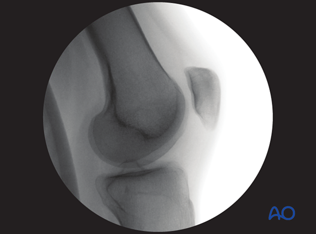 Optimal lateral view of patella