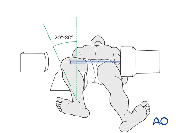 Positioning for optimal accessory view of the lateral facet