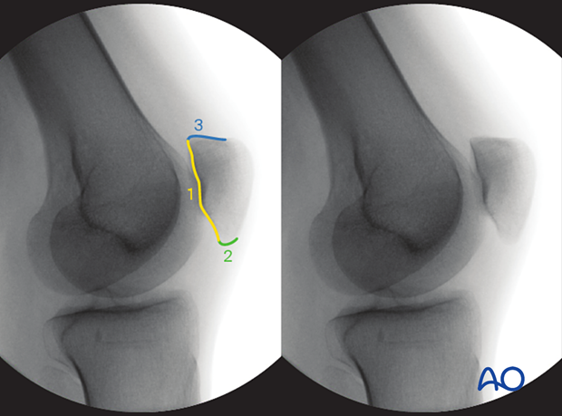 34 X550 Intraoperative imaging of the patella